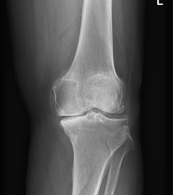 Knee pain treated with stem cells