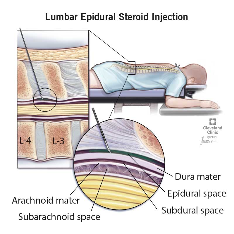 spine injection stem cells
