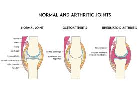 stem cell treatment for arthritis