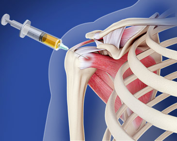 Shoulder treatment with stem cells